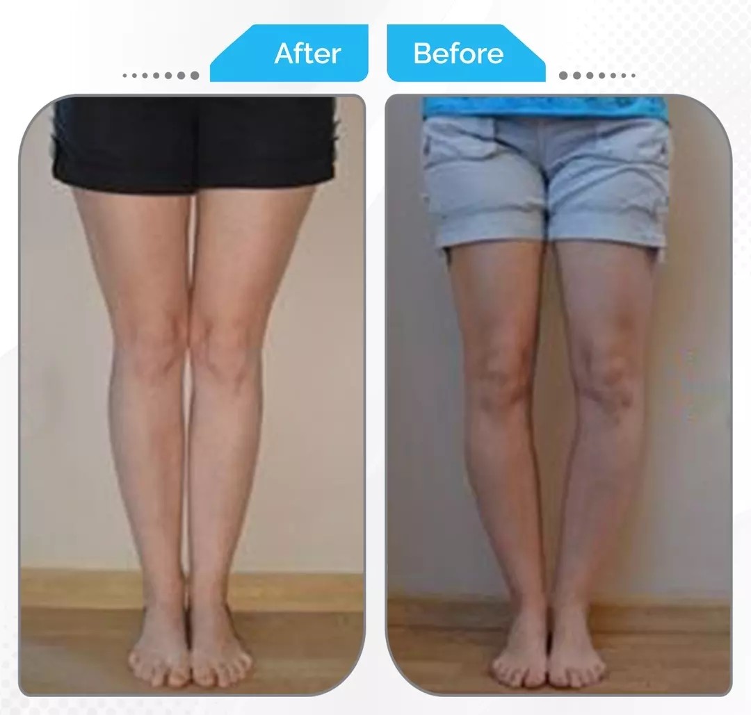 Bow legs correction surgery before and after results by Dr. Fawzy Issa in Kuwait