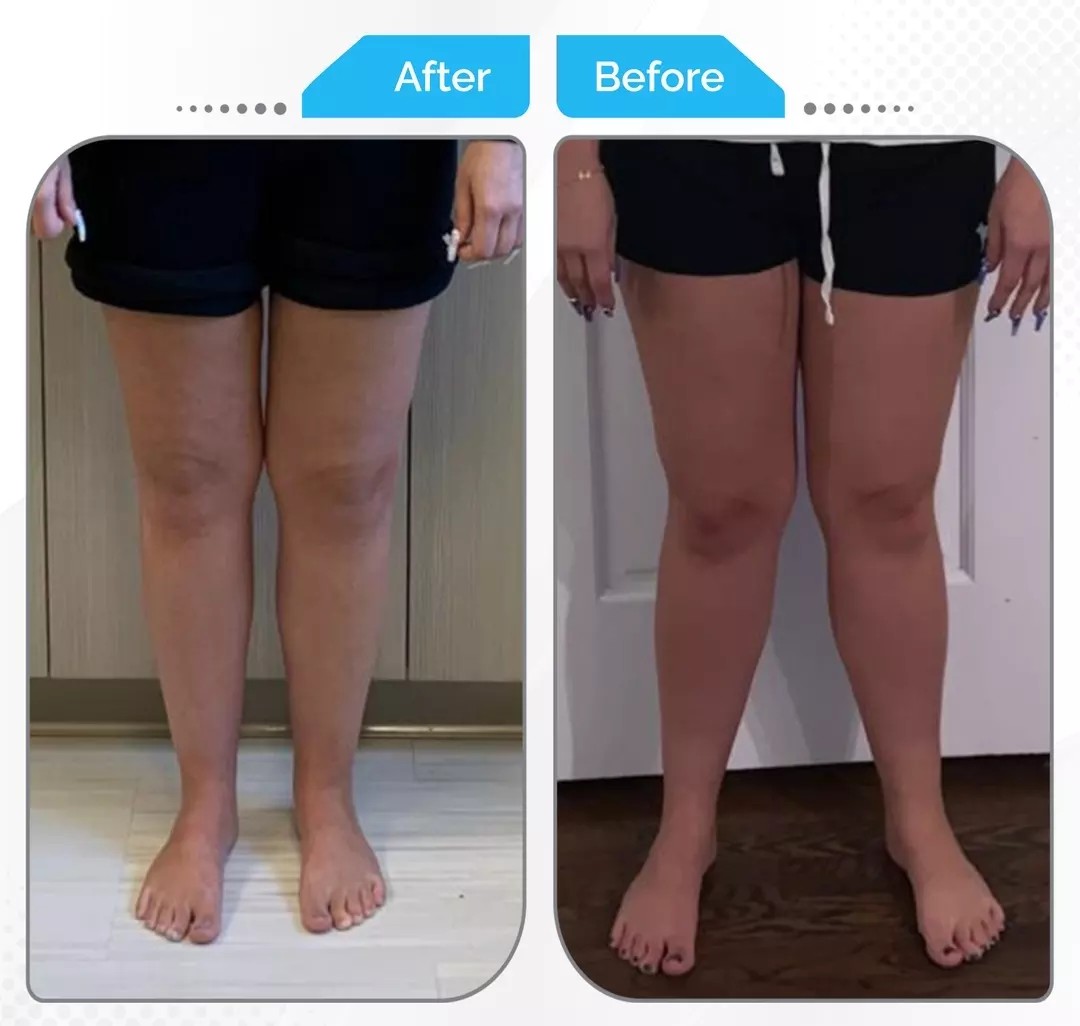Bow legs correction surgery before and after results by Dr. Fawzy Issa in Kuwait