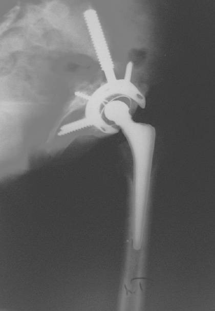 Dr. Fawzy Issa BOA-nominated modular acetabular cage system innovation for complex revision surgery